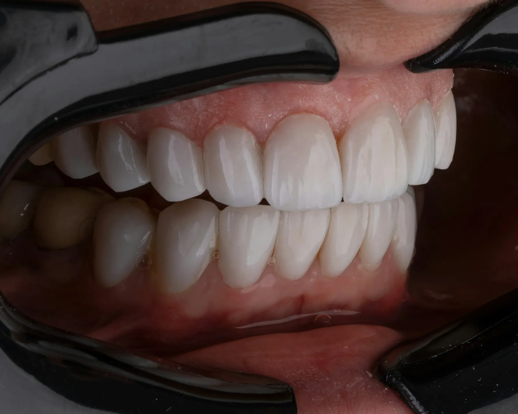 Close view of a bright, freshly-treated smile